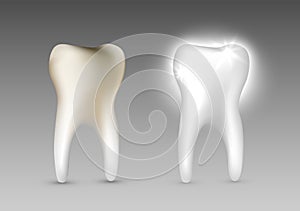 Beautiful realistic dentist vector set of decayed and white shiny tooth on grey background