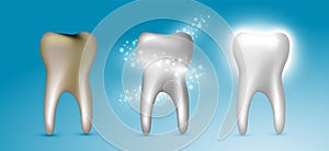 Beautiful realistic dentist vector set of teeth cleansing process with decayed, cleansed and white shiny teeth on blue background