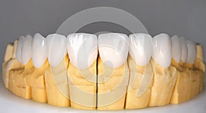 Beautiful upper teeth ceramic press veneers bleach of zircon arch prothesis Implants crowns. Dental restoration treatment clinic