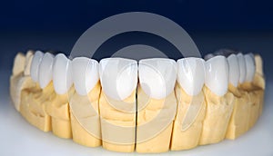 Beautiful upper teeth ceramic press veneers bleach of zircon arch prothesis Implants crowns. Dental restoration treatment clinic