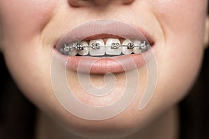 Beautiful White Teeth with Braces. Dental Care Photo. Woman Smile with Ortodontic Accessories. Orthodontics Treatment