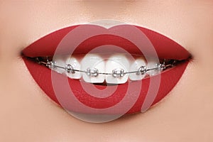 Beautiful white teeth with braces. Dental care photo. Woman smile with ortodontic accessories. Orthodontics treatment