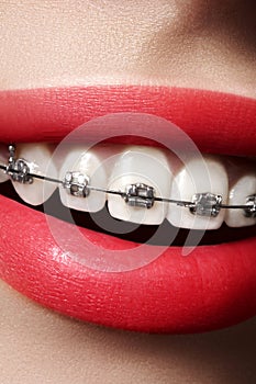 Beautiful white teeth with braces. Dental care photo. Woman smile with ortodontic accessories. Orthodontics treatment