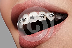 Beautiful white teeth with braces. Dental care photo. Woman smile with ortodontic accessories. Orthodontics treatment