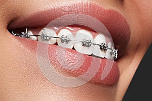 Beautiful white teeth with braces. Dental care photo. Woman smile with ortodontic accessories. Orthodontics treatment