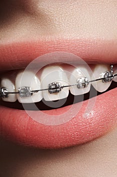 Beautiful white teeth with braces. Dental care photo. Woman smile with ortodontic accessories. Orthodontics treatment