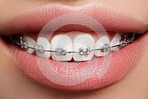 Beautiful white teeth with braces. Dental care photo. Woman smile with ortodontic accessories. Orthodontics treatment