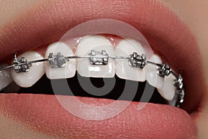 Beautiful white teeth with braces. Dental care photo. Woman smile with ortodontic accessories. Orthodontics treatment