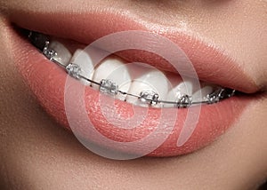 Beautiful white teeth with braces. Dental care photo. Woman smile with ortodontic accessories. Orthodontics treatment