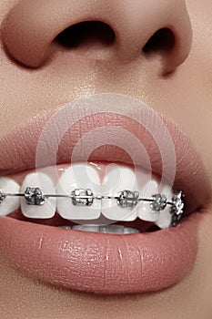 Beautiful white teeth with braces. Dental care photo. Woman smile with ortodontic accessories. Orthodontics treatment