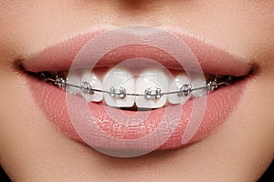 Beautiful white teeth with braces. Dental care photo. Woman smile with ortodontic accessories. Orthodontics treatment