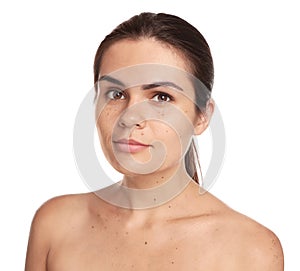 Beautiful woman with birthmarks on white background