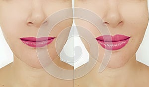 Beautiful woman lips before and after augmentation