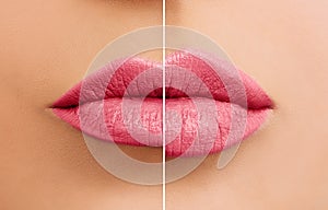 Beautiful woman lips before and after lip filler injections close up photo