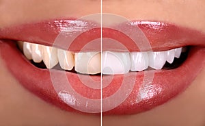 Before After beautiful woman smile . White Teeth ceramic crowns whitening . Dental zircon implants restoration