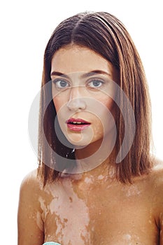 Beautiful young brunette woman with vitiligo disease close up isolated on white positive smiling, model problems concept