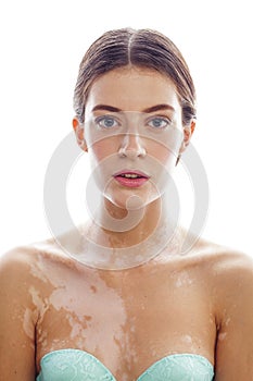 Beautiful young brunette woman with vitiligo disease close up isolated on white positive smiling, model problems concept