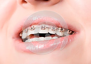 Beautiful young woman with brackets on teeth