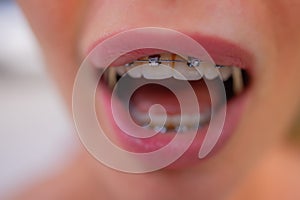 Beautiful young woman with brackets on teeth close up.