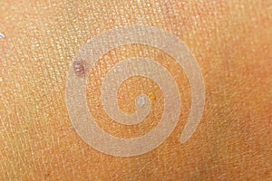 Beauty spot freckle fleck on tanned human skin photo