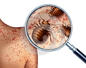 Bed Bug Bites