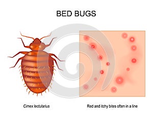 Bed bug. Close-up of skin with Red and itchy bites