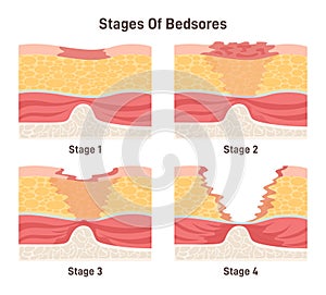 Bedsore stages set. Pressure sores areas on human body parts. Pressure
