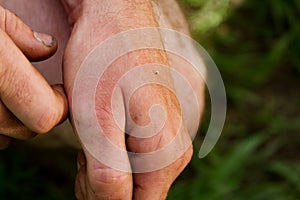 Bee sting on hand