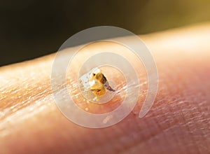 A bee stung a man's finger