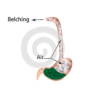 Belching. Air in the stomach. The structure of the esophagus and stomach. Infographics. Vector illustration