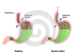 Belching, Heartburn or reflux