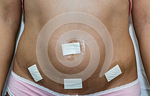 Belly of a young woman after laparoscopy surgery. White background. The abdomen is sealed with a patch after surgery to remove the