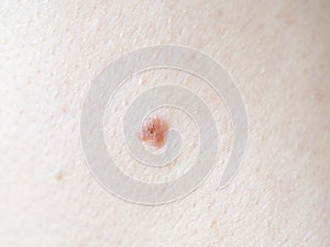 Benign moles on human skin, close up