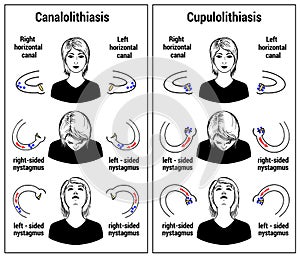 benign paroxysmal positional vertigo canalolithiasis cupulolithiasis Illustration