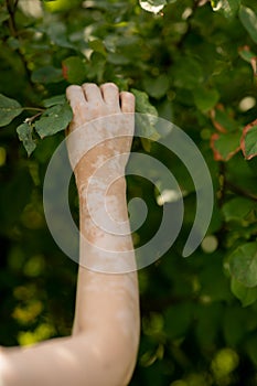 Benign pigmentation of the skin of the hands. White-brown leather. Melasma.