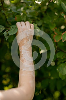 Benign pigmentation of the skin of the hands. White-brown leather. Melasma.