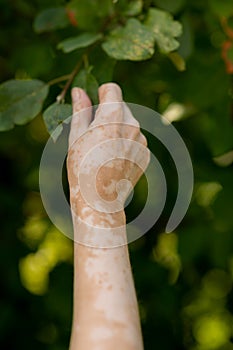 Benign pigmentation of the skin of the hands. White-brown leather. Melasma.