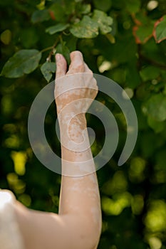 Benign pigmentation of the skin of the hands. White-brown leather. Melasma.