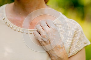 Benign pigmentation of the skin of the hands. White-brown leather. Melasma.