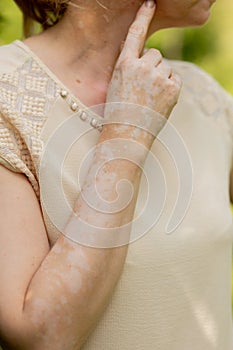 Benign pigmentation of the skin of the hands. White-brown leather. Melasma.