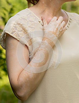 Benign pigmentation of the skin of the hands. White-brown leather. Melasma.