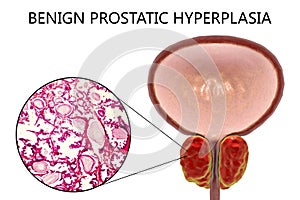 Benign prostatic hyperplasia