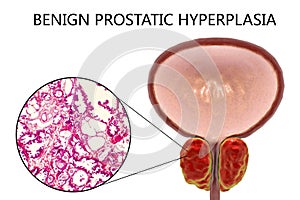 Benign prostatic hyperplasia