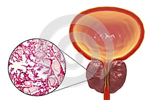 Benign prostatic hyperplasia