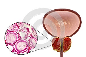 Benign prostatic hyperplasia