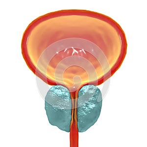 Benign prostatic hyperplasia