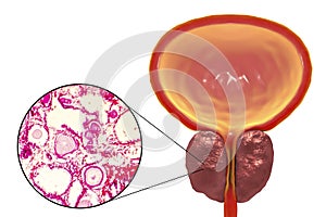 Benign prostatic hyperplasia