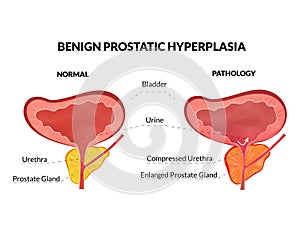 Benign prostatic hyperplasia