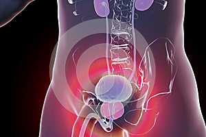 Benign prostatic hyperplasia