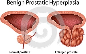 Benign Prostatic Hyperplasia photo